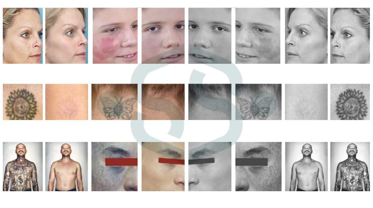 Before Treatment Pico4glow - Picosecond Laser