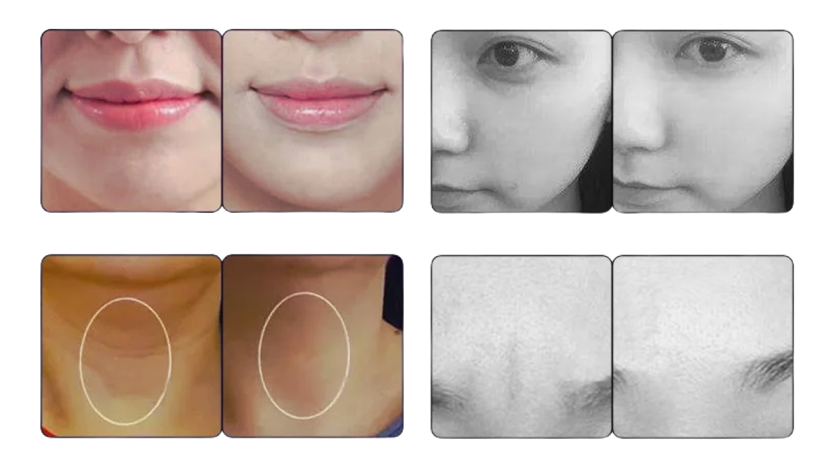 After Treatment Pico4glow - Picosecond Laser