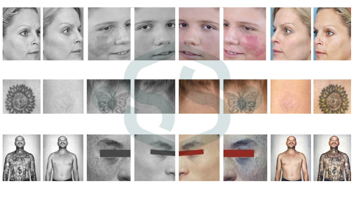 After Treatment Pico4glow - Picosecond Laser