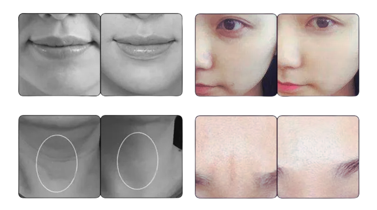 Before Treatment Pico4glow - Picosecond Laser